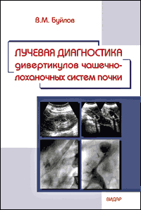 Лучевая диагностика дивертикулов чашечно-лоханочных систем почек