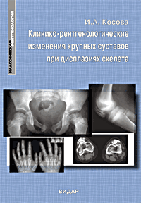 Клинико-рентгенологические изменения крупных суставов при дисплазиях скелета